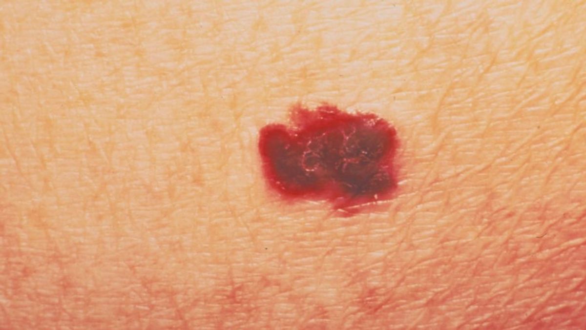 FDA Setujui Obat Baru Replimune untuk Melanoma Stadium Lanjut di AS