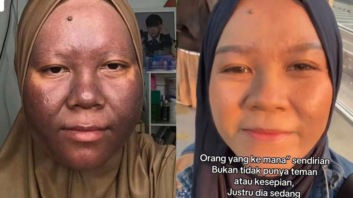 Perempuan Samarinda Pulihkan Kulit Wajah Setelah Terkena Okronosis