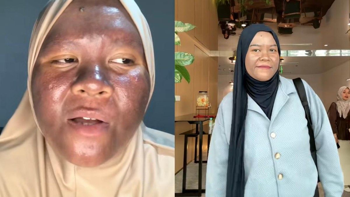 Nur Lenny Astia Berhasil Pulihkan Kulit Wajah Setelah Pakai Krim Berbahaya